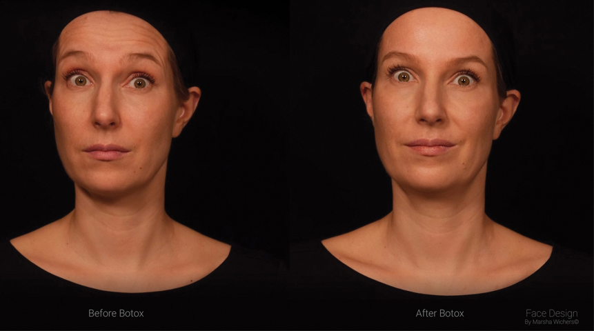 Como o Botóx afeta a expressão facial